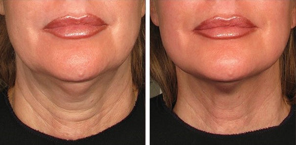 Revive Neck Lift Gel